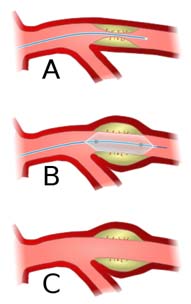 salem-vascular-surgeon-angioplasty