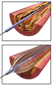 salem-vascular-surgeon-angioplasty