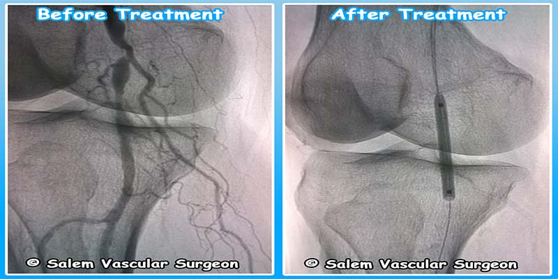 salem-vascular-surgeon-angioplasty