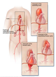 salem-vascular-surgeon-aortic-aneurysm