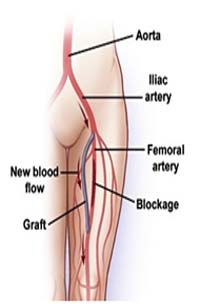 salem-vascular-surgeon-angioplasty