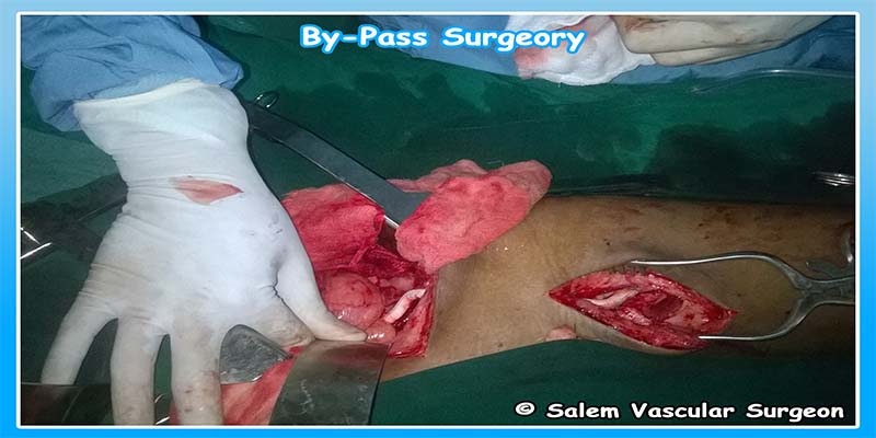 salem-vascular-surgeon-bypass