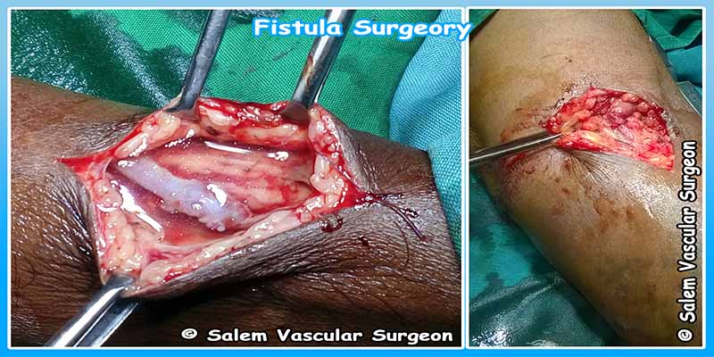 salem-vascular-surgeon-fistula