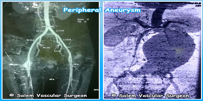 salem-vascular-surgeon-peripheral-aneurysm
