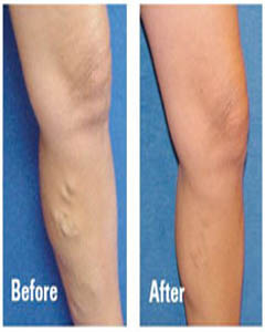 salem-vascular-surgeon-varicose-vein