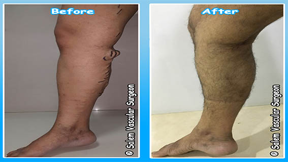 salem-vascular-surgeon-varicose-vein