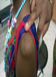 salem-vascular-surgeon-vascular-tumours